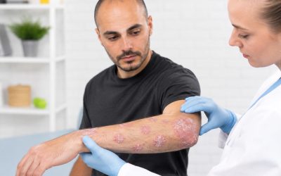 Nueva terapia para la psoriasis llega a Ecuador